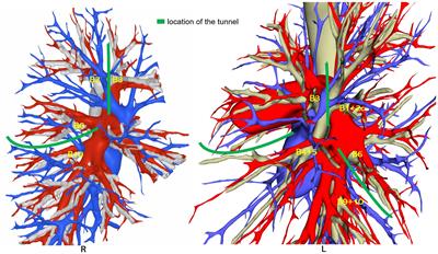 Unveiling the synergetic benefits of the tunneling technique using stapler tractor in precise resection of lung segments: a retrospective cohort study